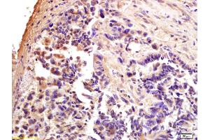 Formalin-fixed and paraffin embedded human rectal carcinoma labeled with Anti-CTCF Polyclonal Antibody, Unconjugated (ABIN703976) at 1:200 followed by conjugation to the secondary antibody and DAB staining. (CTCF Antikörper  (AA 451-550))