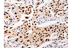The image on the left is immunohistochemistry of paraffin-embedded Human lung cancer tissue using ABIN7128323(AKAP8L Antibody) at dilution 1/20, on the right is treated with fusion protein. (AKAP8L Antikörper)