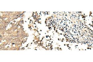 Immunohistochemistry of paraffin-embedded Human lung cancer tissue using CHP1 Polyclonal Antibody at dilution of 1:25(x200)