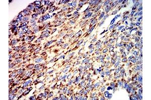 Immunohistochemical analysis of paraffin-embedded lung cancer tissues using ATPIF1 mouse mAb with DAB staining. (ATPase Inhibitory Factor 1 Antikörper  (AA 1-106))