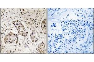 Immunohistochemistry analysis of paraffin-embedded human breast carcinoma tissue, using RCC2 Antibody.