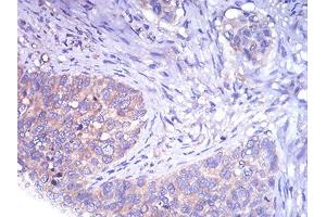 Immunohistochemical analysis of paraffin-embedded cervical cancer tissues using TH mouse mAb with DAB staining. (TH Antikörper  (AA 44-208))