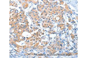 Immunohistochemistry of Human lung cancer using AUP1 Polyclonal Antibody at dilution of 1:50 (Ancient Ubiquitous Protein 1 Antikörper)