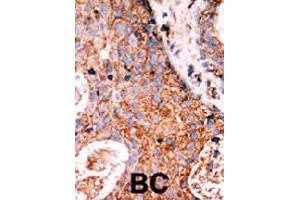 Formalin-fixed and paraffin-embedded human cancer tissue reacted with LMTK2 polyclonal antibody  , which was peroxidase-conjugated to the secondary antibody, followed by DAB staining. (LMTK2 Antikörper  (N-Term))