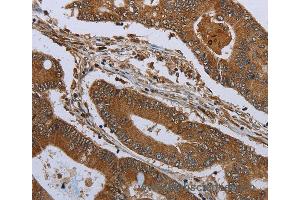 Immunohistochemistry of Human colon cancer using KLRF1 Polyclonal Antibody at dilution of 1:30 (KLRF1 Antikörper)