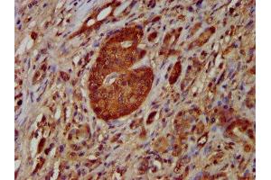 IHC image of ABIN7161669 diluted at 1:100 and staining in paraffin-embedded human pancreatic cancer performed on a Leica BondTM system. (NOMO1 Antikörper  (AA 918-1044))