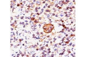 IHC testing of Hodgkin's lymphoma stained with Bax antibody (Clone 2D2). (BAX Antikörper)