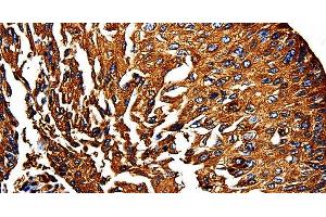 Immunohistochemistry of paraffin-embedded Human lung cancer using PKM Polyclonal Antibody at dilution of 1:50 (PKM Antikörper)