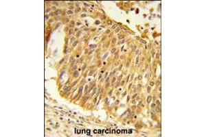 Formalin-fixed and paraffin-embedded human lung carcinoma reacted with EEFSEC Antibody , which was peroxidase-conjugated to the secondary antibody, followed by DAB staining. (EEFSEC Antikörper  (C-Term))