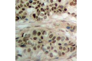 Immunohistochemical analysis of PBOV1 staining in human prostate cancer formalin fixed paraffin embedded tissue section.