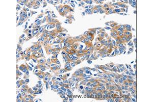 Immunohistochemistry of Human lung cancer using CCL6 Polyclonal Antibody at dilution of 1:50