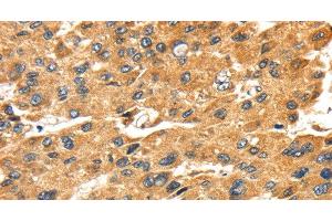 Immunohistochemistry of paraffin-embedded Human liver cancer tissue using SH3KBP1 Polyclonal Antibody at dilution 1:45 (SH3KBP1 Antikörper)