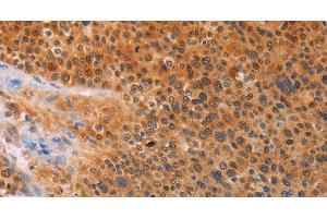 Immunohistochemistry of paraffin-embedded Human liver cancer tissue using ADHFE1 Polyclonal Antibody at dilution 1:30