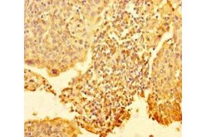 Immunohistochemistry of paraffin-embedded human cervical cancer using ABIN7168303 at dilution of 1:100 (RTF1 Antikörper  (AA 620-670))