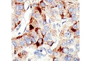 IHC analysis of FFPE human hepatocarcinoma stained with the Dnmt2 antibody (Dnmt2 Antikörper  (AA 201-230))
