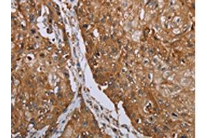 The image on the left is immunohistochemistry of paraffin-embedded Human esophagus cancer tissue using ABIN7192846(TNPO1 Antibody) at dilution 1/25, on the right is treated with synthetic peptide. (Transportin 1 Antikörper)
