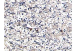 DAB staining on IHC-P; Samples: Human Renal cancer Tissue (S100A8 Antikörper  (AA 1-93))