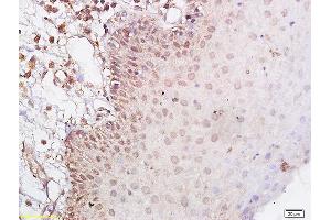 Formalin-fixed and paraffin embedded human laryngeal cancer labeled with Anti-CD44v5 Polyclonal Antibody, Unconjugated (ABIN680623) at 1:200 followed by conjugation to the secondary antibody (CD44RC (AA 61-139) Antikörper)