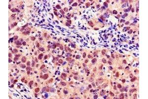 Immunohistochemistry of paraffin-embedded human pancreatic cancer using ABIN7160378 at dilution of 1:100 (MYBL2 Antikörper  (AA 188-366))