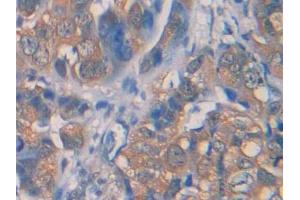 DAB staining on IHC-P; Samples: Human Breast cancer Tissue (IL1R1 Antikörper  (AA 226-318))