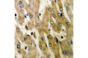 Immunohistochemical analysis of ACOT4 staining in human liver cancer formalin fixed paraffin embedded tissue section. (ACOT4 Antikörper  (C-Term))