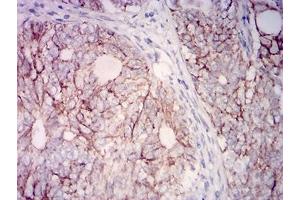 Immunohistochemical analysis of paraffin-embedded cervical cancer tissues using CD315 mouse mAb with DAB staining. (PTGFRN Antikörper  (AA 46-221))