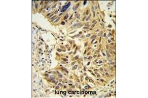 SDR Antibody (Center) (ABIN653890 and ABIN2843136) IHC analysis in formalin fixed and paraffin embedded lung carcinoma followed by peroxidase conjugation of the secondary antibody and DAB staining. (SDPR Antikörper  (AA 109-135))