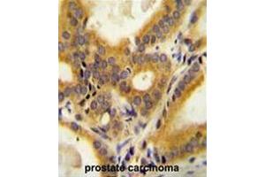 CC85C Antibody (N-term) immunohistochemistry analysis in formalin fixed and paraffin embedded human prostate carcinoma followed by peroxidase conjugation of the secondary antibody and DAB staining. (CCDC85C Antikörper  (N-Term))
