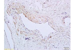 Formalin-fixed and paraffin embedded human cervical carcinoma tissue labeled with Anti-SynCAM/TSLC1 Polyclonal Antibody, Unconjugated  at 1:200 followed by conjugation to the secondary antibody and DAB staining (CADM1 Antikörper  (AA 365-442))