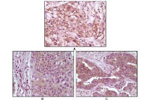 Immunohistochemical analysis of paraffin-embedded human pancreas carcinoma (A), esophagus carcinoma tissue (B) and ovary tumor tissue (C), showing cytoplasmic and membrane localization using 4E-BP1 mouse mAb with DAB staining. (eIF4EBP1 Antikörper)