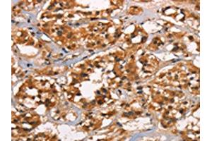 The image on the left is immunohistochemistry of paraffin-embedded Human thyroid cancer tissue using ABIN7190032(CABLES2 Antibody) at dilution 1/25, on the right is treated with synthetic peptide. (CABLES2 Antikörper)