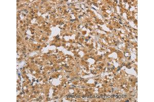 Immunohistochemistry of Human cervical cancer using DIDO1 Polyclonal Antibody at dilution of 1:50 (DIO1 Antikörper)