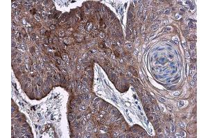 IHC-P Image ELA3A antibody detects ELA3A protein at cytoplasm in human esophagus carcinoma by immunohistochemical analysis. (Elastase 3A Antikörper)