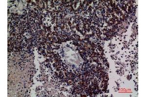 Immunohistochemistry (IHC) analysis of paraffin-embedded Human Lung Cancer, antibody was diluted at 1:100. (DCI Antikörper  (C-Term))