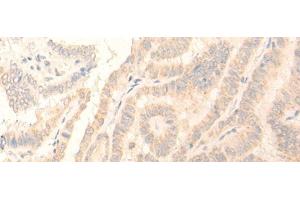 Immunohistochemistry of paraffin-embedded Human thyroid cancer tissue using ADGRE3 Polyclonal Antibody at dilution of 1:35(x200) (EMR3 Antikörper)