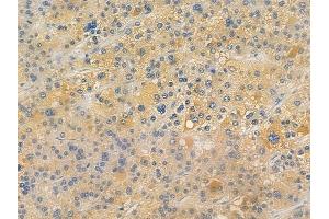 ABIN7096403 and ABIN7100467 at 1/100 staining human hepatocellular carcinoma by IHC-P. (TIMMDC1 Antikörper)