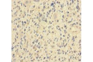 Immunohistochemistry of paraffin-embedded human glioma using ABIN7155411 at dilution of 1:100 (HIST1H2BN Antikörper  (AA 2-126))