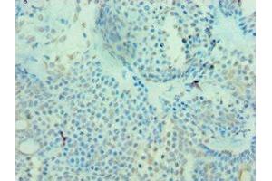 Immunohistochemistry of paraffin-embedded human breast cancer using ABIN7159680 at dilution of 1:100 (MICA Antikörper  (AA 24-307))