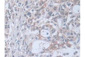 Detection of SNAP23 in Human Stomach cancer Tissue using Polyclonal Antibody to Synaptosomal Associated Protein 23 kDa (SNAP23)