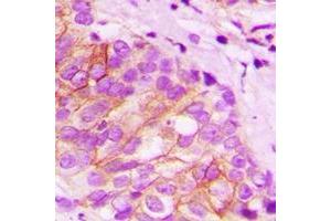 Immunohistochemical analysis of Tapasin staining in human breast cancer formalin fixed paraffin embedded tissue section. (TAPBP Antikörper  (full length))