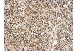 IHC-P Image Immunohistochemical analysis of paraffin-embedded AGS xenograft, using hnRNP 1, antibody at 1:500 dilution. (PTBP1 Antikörper)