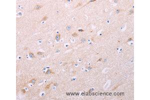 Immunohistochemistry of Human thyroid cancer using ADCY5 Polyclonal Antibody at dilution of 1:40 (ADCY5 Antikörper)