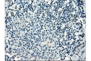 Immunohistochemical staining of paraffin-embedded Adenocarcinoma of colon tissue using anti-PDE10A mouse monoclonal antibody. (PDE10A Antikörper)
