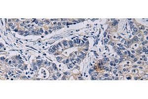 Immunohistochemistry of paraffin-embedded Human gastric cancer tissue using CHST3 Polyclonal Antibody at dilution of 1:35(x200)