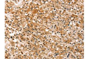 The image on the left is immunohistochemistry of paraffin-embedded Human prostate cancer tissue using ABIN7192485(SLC40A1 Antibody) at dilution 1/20, on the right is treated with synthetic peptide. (Band 3/AE1 Antikörper)