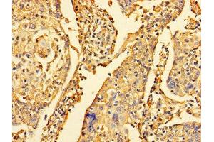Immunohistochemistry of paraffin-embedded human cervical cancer using ABIN7150882 at dilution of 1:100