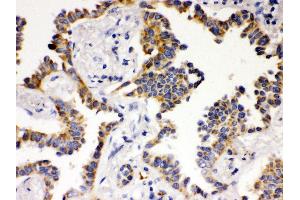 Anti- ATG14L Picoband antibody, IHC(P) IHC(P): Human Lung Cancer Tissue (ATG14 Antikörper  (N-Term))