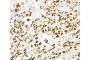 Immunohistochemistry of paraffin-embedded Human kidney cancer using SMAD9 Polyclonal Antibody at dilution of 1:100 (40x lens). (SMAD9 Antikörper)