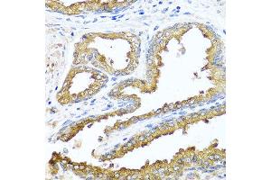 Immunohistochemistry of paraffin-embedded human prostate using NCK2 antibody at dilution of 1:100 (x40 lens). (NCK2 Antikörper)