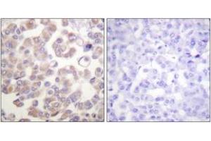 Immunohistochemistry analysis of paraffin-embedded human breast carcinoma tissue, using WNT1 Antibody. (WNT1 Antikörper  (AA 301-350))